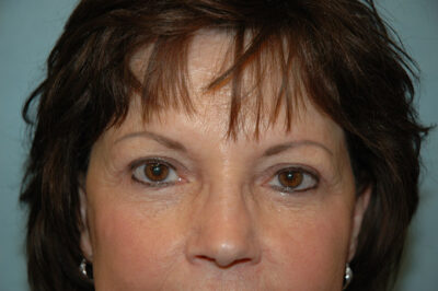 Blepharoplasty & Browlift