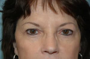 Blepharoplasty & Browlift