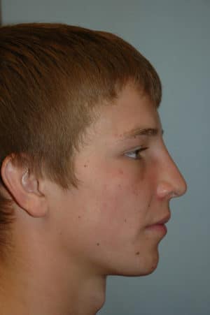 Rhinoplasty Case 235 After Photo Rhinoplasty
