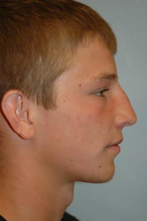Rhinoplasty Case 235 Before Photo Rhinoplasty