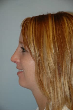 Rhinoplasty Case 229 After Photo Rhinoplasty