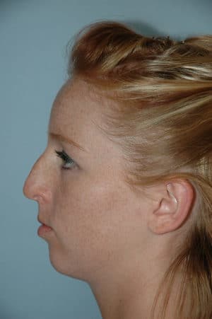 Rhinoplasty Case 229 Before Photo Rhinoplasty