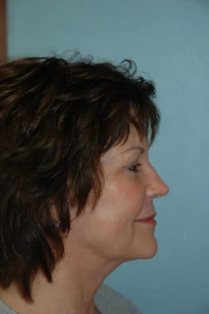 Face & Neck Lift Case 153 After Photo Face & Neck Lift