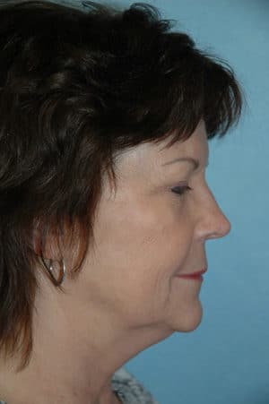 Face & Neck Lift Case 153 Before Photo Face & Neck Lift
