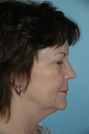 Face & Neck Lift