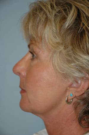 Face & Neck Lift