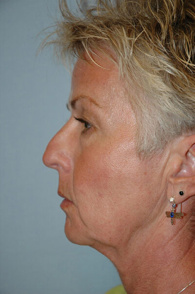 Face & Neck Lift