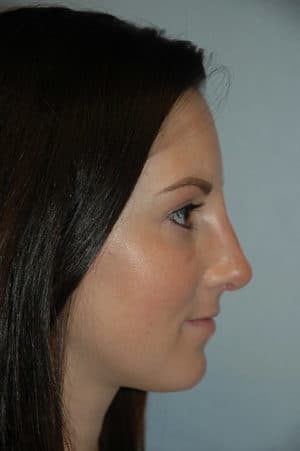 Rhinoplasty Case 232 After Photo Rhinoplasty