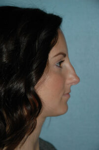 Rhinoplasty