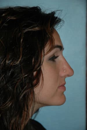 Rhinoplasty Case 234 After Photo Rhinoplasty
