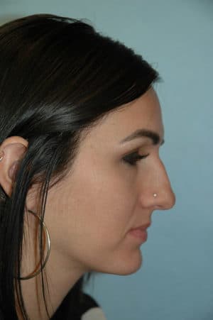 Rhinoplasty Case 234 Before Photo Rhinoplasty
