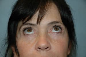 Blepharoplasty & Browlift