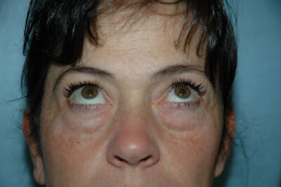 Blepharoplasty & Browlift
