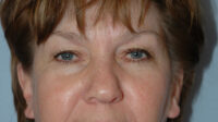 Blepharoplasty & Browlift