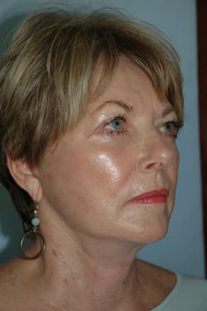 Face & Neck Lift