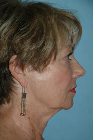 Face & Neck Lift