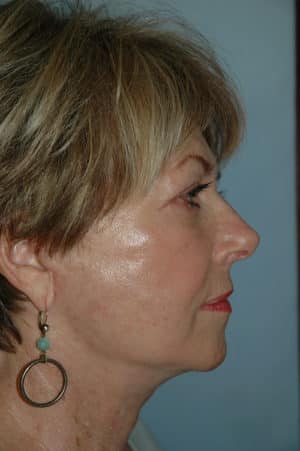 Face & Neck Lift