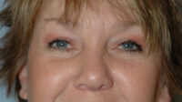 Blepharoplasty & Browlift
