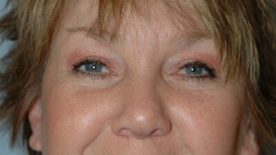 Blepharoplasty & Browlift