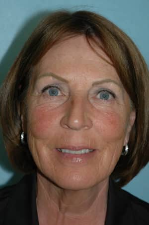 Face & Neck Lift Case 157 Before Photo Face & Neck Lift