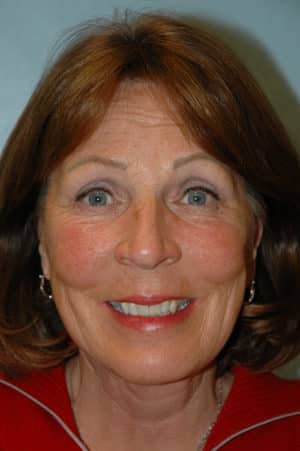 Face & Neck Lift Case 157 After Photo Face & Neck Lift