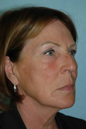 Face & Neck Lift Case 157 Before Photo Face & Neck Lift