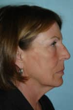 Face & Neck Lift