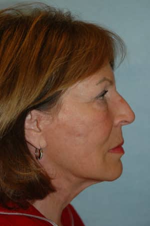 Face & Neck Lift Case 157 After Photo Face & Neck Lift