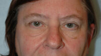 Blepharoplasty & Browlift