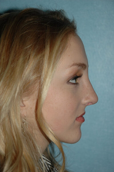 Rhinoplasty