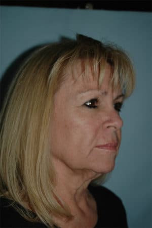 Face & Neck Lift Case 154 Before Photo Face & Neck Lift