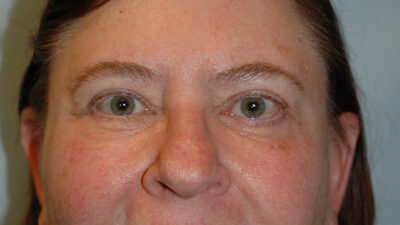 Blepharoplasty & Browlift