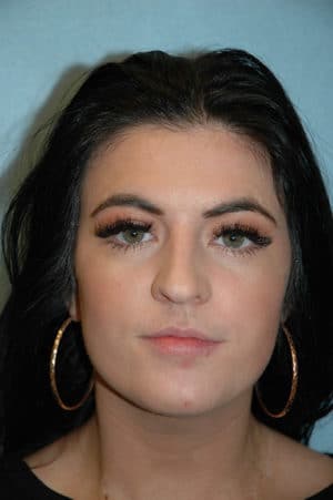 Rhinoplasty Case 251 Before Photo Rhinoplasty