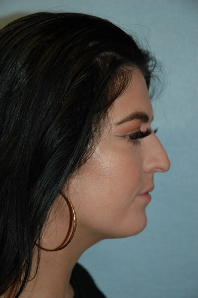 Rhinoplasty