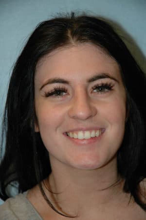 Rhinoplasty Case 251 After Photo Rhinoplasty
