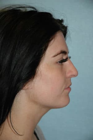 Rhinoplasty Case 251 After Photo Rhinoplasty