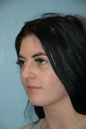 Rhinoplasty Case 251 After Photo Rhinoplasty