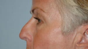 Blepharoplasty & Browlift Case 198 Before Photo Blepharoplasty & Browlift