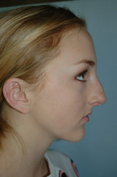 Rhinoplasty