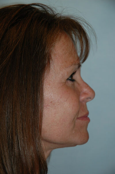 Face & Neck Lift