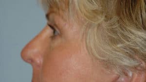 Blepharoplasty & Browlift Case 198 After Photo Blepharoplasty & Browlift