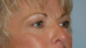 Blepharoplasty & Browlift Case 198 After Photo Blepharoplasty & Browlift