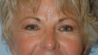 Blepharoplasty & Browlift