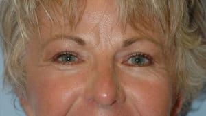 Blepharoplasty & Browlift Case 198 After Photo Blepharoplasty & Browlift