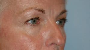 Blepharoplasty & Browlift Case 198 Before Photo Blepharoplasty & Browlift