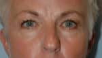 Blepharoplasty & Browlift