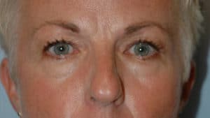 Blepharoplasty & Browlift Case 198 Before Photo Blepharoplasty & Browlift
