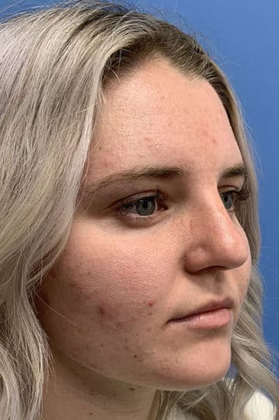 Rhinoplasty Case 473 After Photo Rhinoplasty