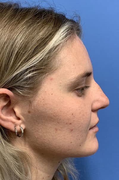 Rhinoplasty Case 473 Before Photo Rhinoplasty