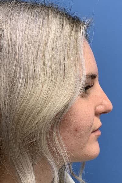 Rhinoplasty Case 473 After Photo Rhinoplasty